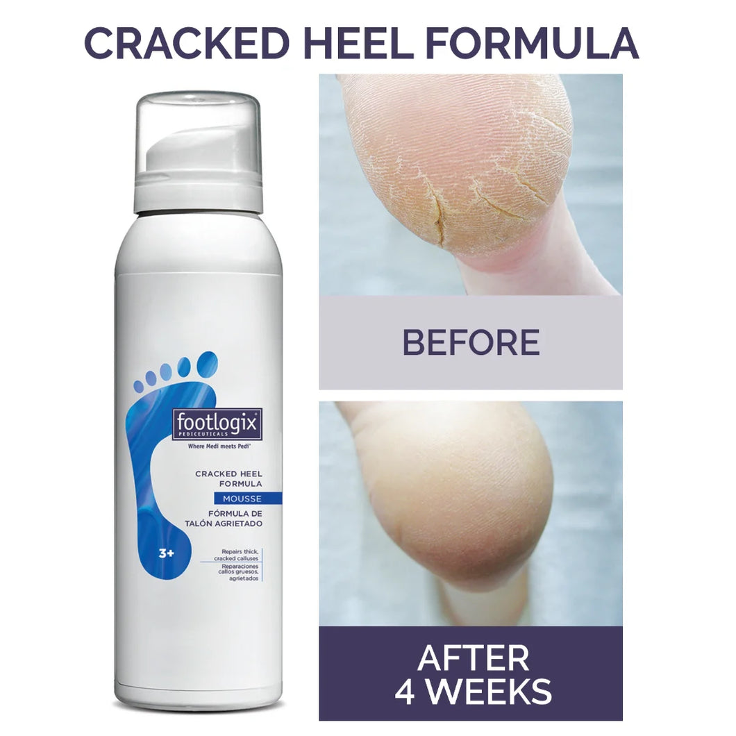 Footlogix Cracked Heel Mousse Formula 125ml