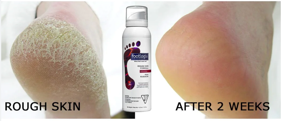 Footlogix Rough Skin Mousse Formula 125ml