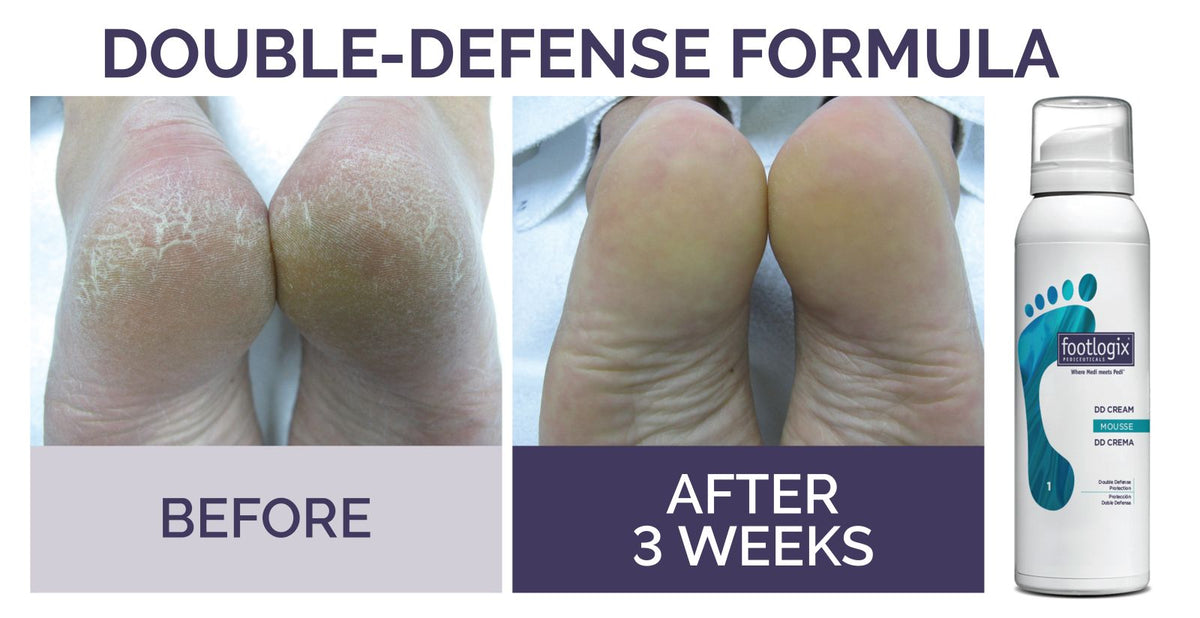 Footlogix (DD) Double Defence Cream Mousse Formula 125ml