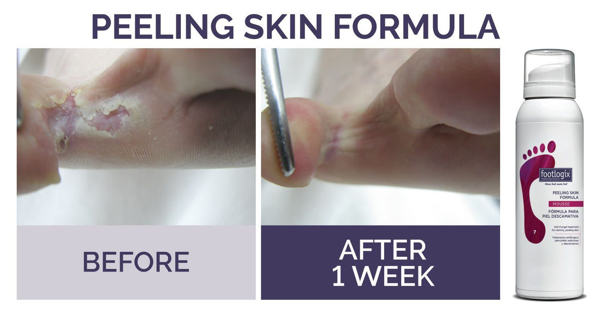 Footlogix Peeling Skin Mousse Formula 125ml